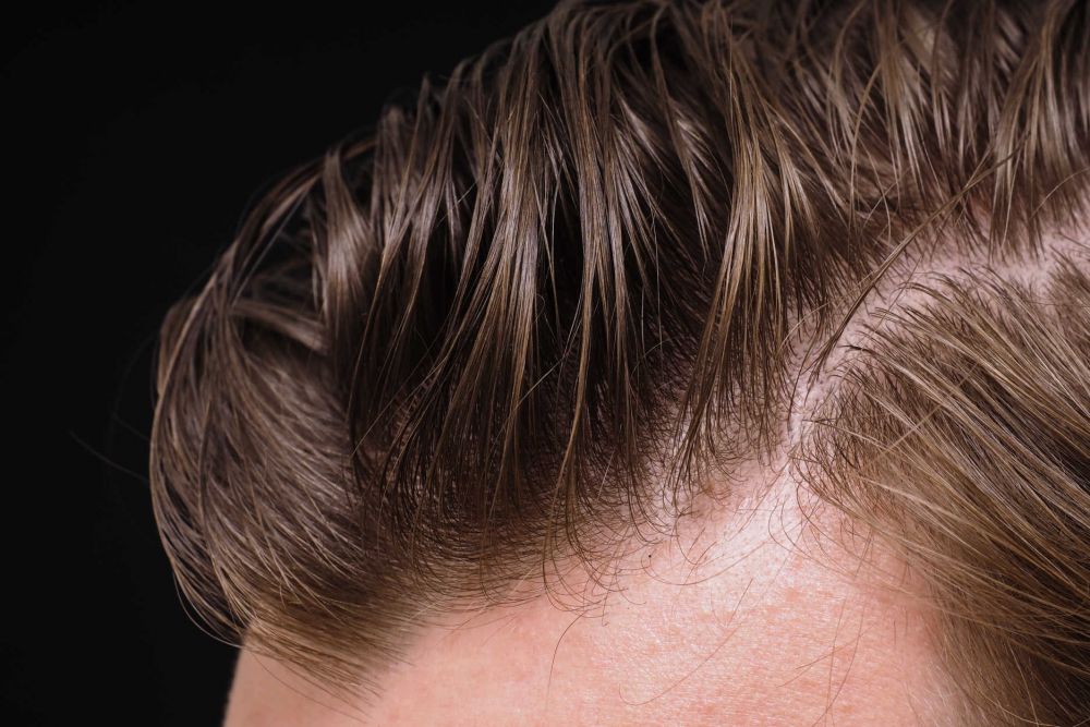 Je možné zastavit dědičné vypadávání vlasů?
