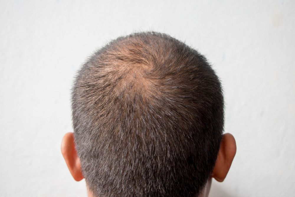 Boj s vypadáváním vlasů: Efektivní řešení krok za krokem